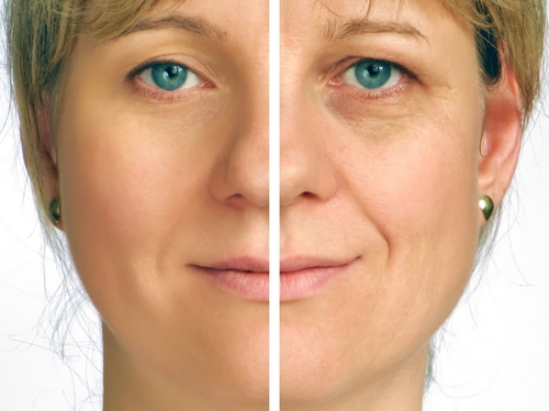 Correction of wrinkles on half of face